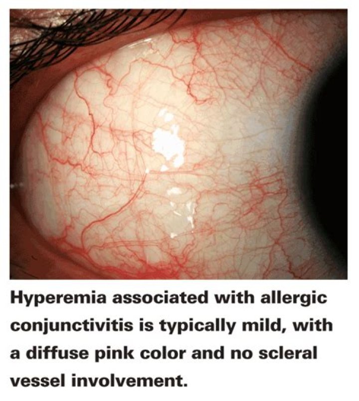 What causes Hyperaemia